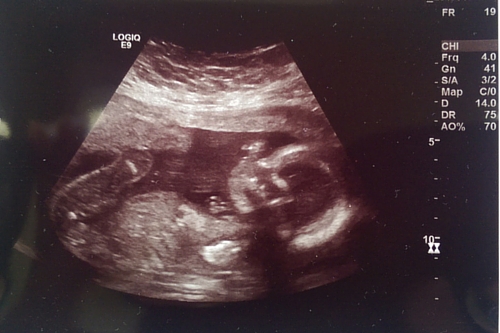 20 week baby ultrasound - the bump diaries
